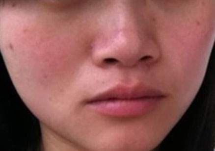 如何判斷自己是不是敏感性皮膚？